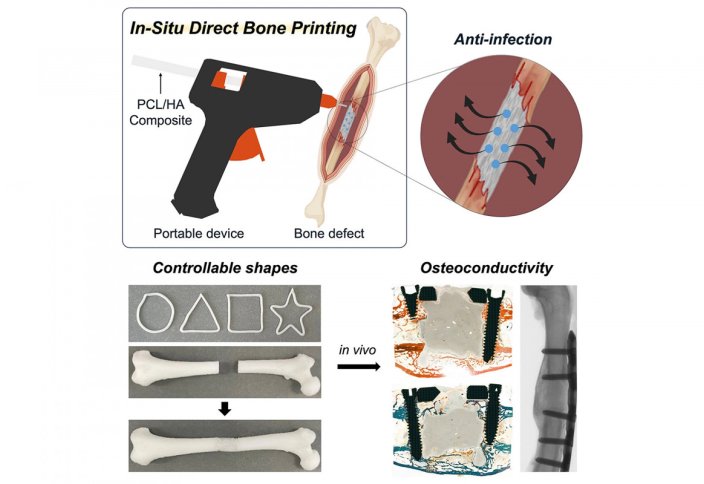Желімді тапанша ота кезінде сынған сүйектерге арналған "жамауларды" басып шығаруға мүмкіндік береді