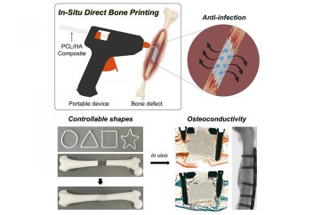 Желімді тапанша ота кезінде сынған сүйектерге арналған "жамауларды" басып шығаруға мүмкіндік береді