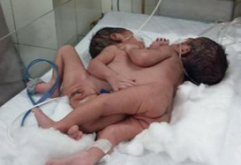 Үндістанда сиам егіздері дүниеге келді (ВИДЕО)