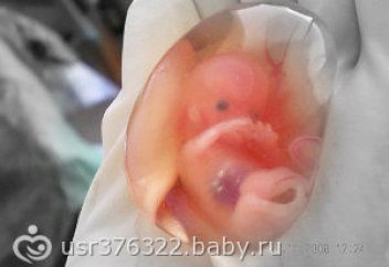 Өткен жылы елімізде қанша әйел түсік жасатты?