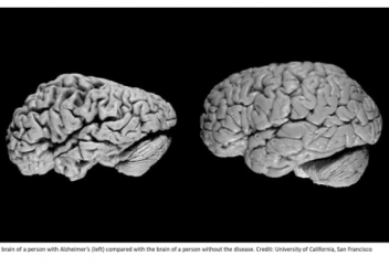 Алжу ауруына шалдығу қатері жоғары адамдар тобы белгілі болды