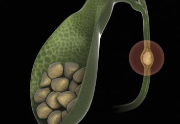 Российские учёные нашли способ избавиться от камней без операции