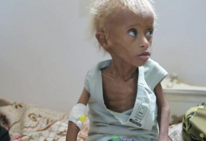 BBC: в Йемене на грани вымирания – целое поколение (Видео)