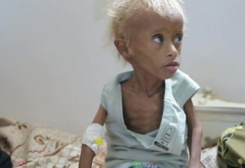 BBC: в Йемене на грани вымирания – целое поколение (Видео)