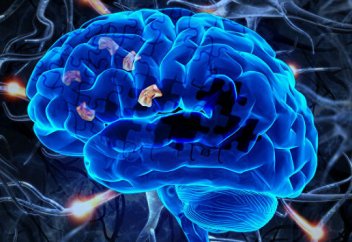 Альцгеймер ауруын емдеудің мүлдем тың тәсілі пайда болды