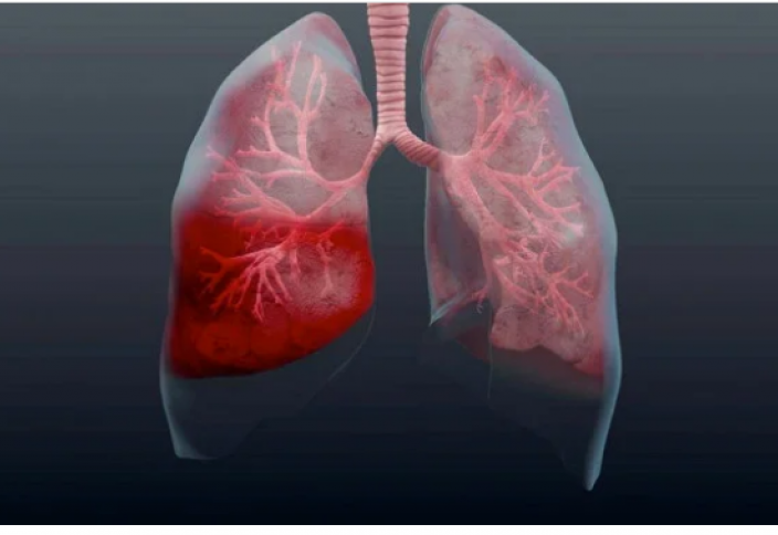 От чего бывает пневмония: дисбактериоз в легких