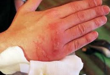 Күйіп қалғанда не істеу керек?