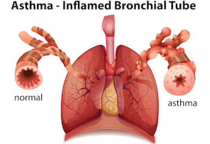 Астма ежегодно уносит жизни более 450 тыс. человек в мире