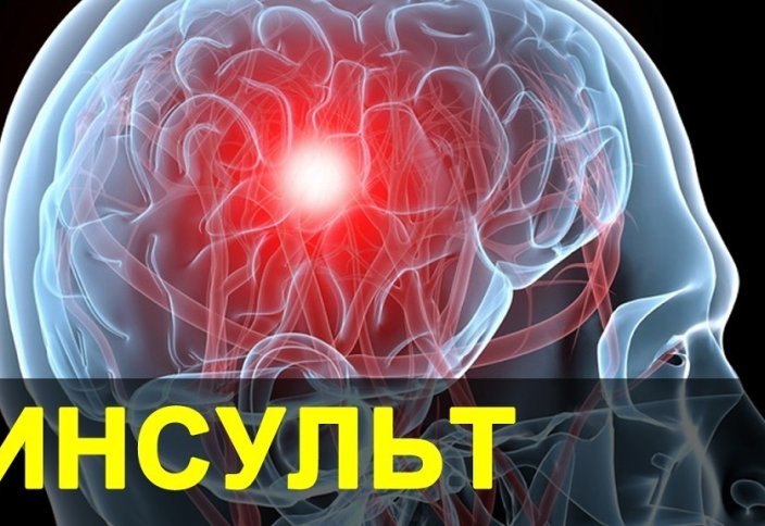 Бүкіл әлемде инсульт алғандар қарасы көбейіп барады