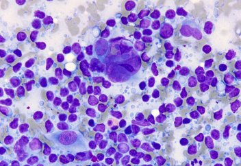 Күйзеліс (депрессия) иммундық жасушалардың өзіндік ерекшелігін өзгертеді. Күйзеліс қабынуды тудырады