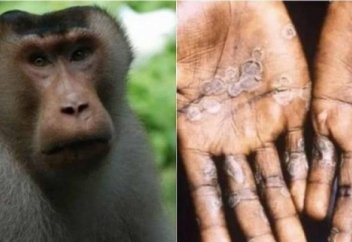 Первый случай оспы обезьян выявлен в Турции