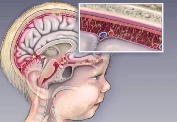 Жыл басынан бері 199 бала серозды менингит инфекциясымен ауырған