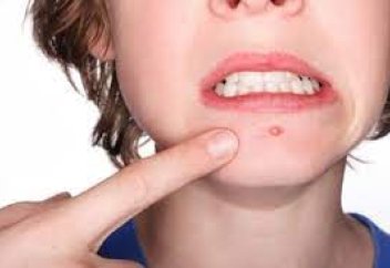 Еуропалық ғалымдар адамның терісін безеуден қорғайтын бактерия ойлап тапты