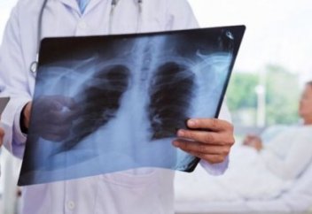 Онколог қандай ауру түрлері өкпе қатерлі ісігіне әкеп соғатынын айтты