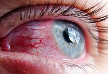 Аурудың бұл 6 нышаны қатерлі ісікке шалдыққаныңыздан белгі береді