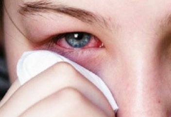 Көздің қанталауы: себебі мен айығу жолдары