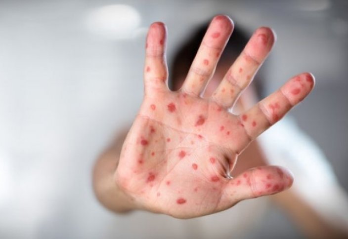 ЮНИСЕФ: миллионы детей не прививаются от кори