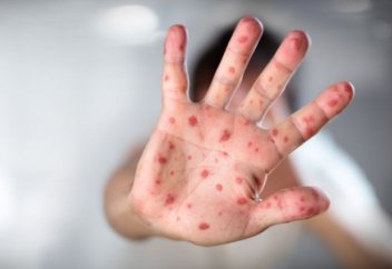 ЮНИСЕФ: миллионы детей не прививаются от кори