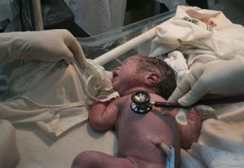 Кесар тілігі адамның даму эволюциясына ықпал етуде