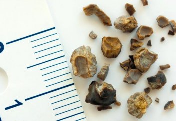 Бүйректегі тасты отасыз жоюдың жолы табылды