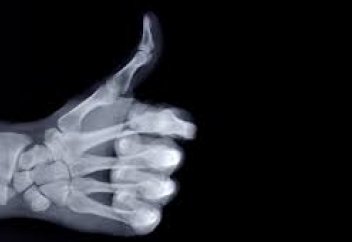 Ғалымдар организмнің өзінде сүйекті басып шығару тәсілін ұсынды (видео)