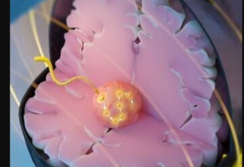 Қатерлі ісікке қарсы өзгеше ем түрі пайда болды