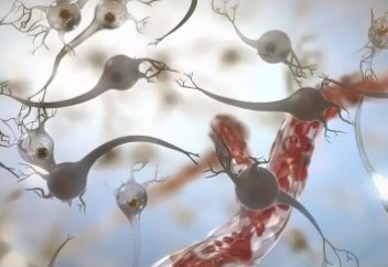 Сал ауруына шалдыққан адамдар үшін жоғары дәлдіктегі нейроимплант жасалды