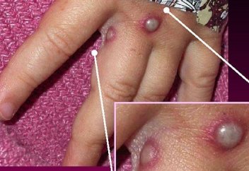 Оспа обезьян: Власти Индонезии принимают профилактические меры