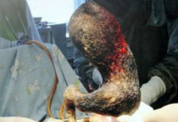 Дәрігерлер 18 жасар қыздың асқазанынан 4 келі шаш алды