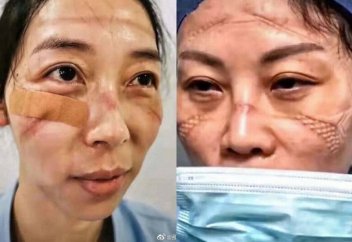 Как выглядят лица китайских врачей в конце рабочей смены (фото)