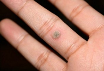 Сүйел қайдан пайда болады және одан қалай құтыла аламыз