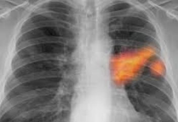 Қан жасушасындағы нанобөлшектер өкпедегі метастазды емдеді