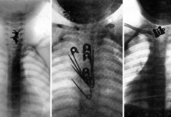 Биыл елімізде денеге бөгде зат енуі салдарынан қанша адам қаза болған
