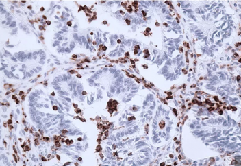 Иммунитет арқылы зиянды жасушалармен күресудің тәсілі табылды