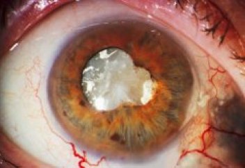 Ғалымдар адамды тұңғыш рет анабиоз халіне келтірді