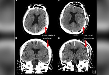 Тұңғыш рет өмірден үзіліп бара жатқан адамның ми белсенділігі таспаға тартылды