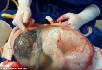 Испанияда нәресте “жейдемен” туды (фото, видео)