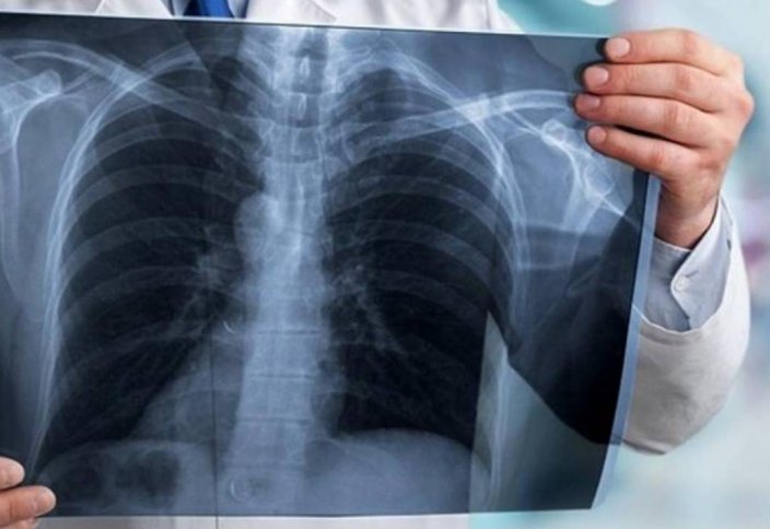 В Казахстане утвердили правила по профилактике и лечению туберкулеза