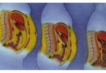 Почему растет живот и как с этим бороться