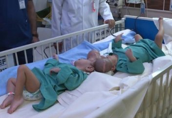 Врачи-мусульмане провели сложнейшую операция по разделению Юсуфа и Ясина