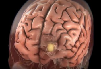 Алжу қатерін арттыратын тағы бір ауру белгілі болды