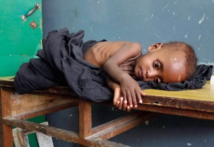 Разное: Более 1 млн детей до 5 лет в Сомали страдают от голода