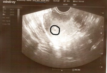 Түсік жасатуға  қатысты ережеге өзгеріс енгізілді