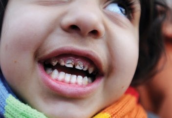 Әлемдегі балалардың үштен бірі қорғасынмен уланған