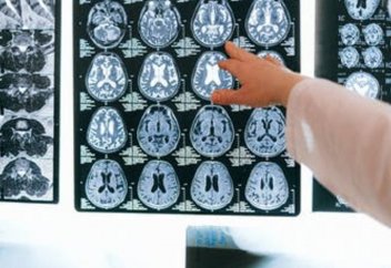 Алжудан қорғайтын ген табылды