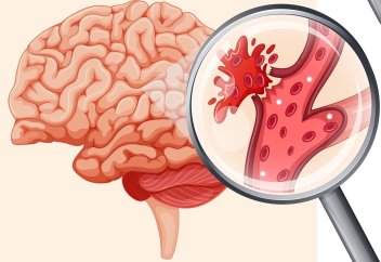 Қандай адамдардың ұйқыда жатып инсульт алу қатері жоғары болады