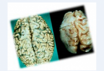 Алкоголь и мозг: культовый доклад академика Углова в 1983 году