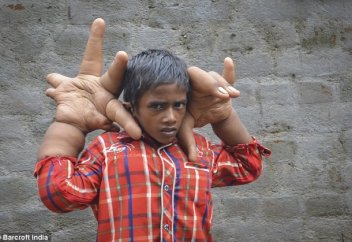 Қолы үлкейіп кеткен баланың диагнозы анықталмай отыр (фото)