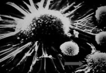 Иранда обырмен ауыратындар саны әлемдік орташа көрсеткіштен әлдеқайда төмен