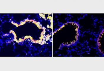 Ғалымдар иммундық жүйені қатерлі ісіктің бетін қайтаруға мәжбүрлей алды